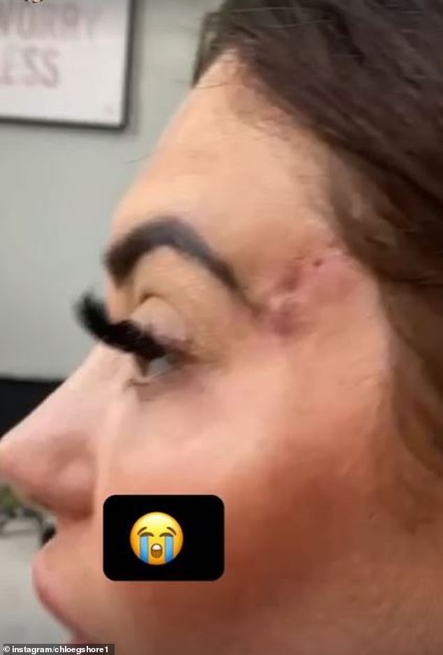 The TV personality had been left with a major ID after a botched 'fox eye facelift' in 2022, but has now proudly shown off the results of the treatment to fade the mark.