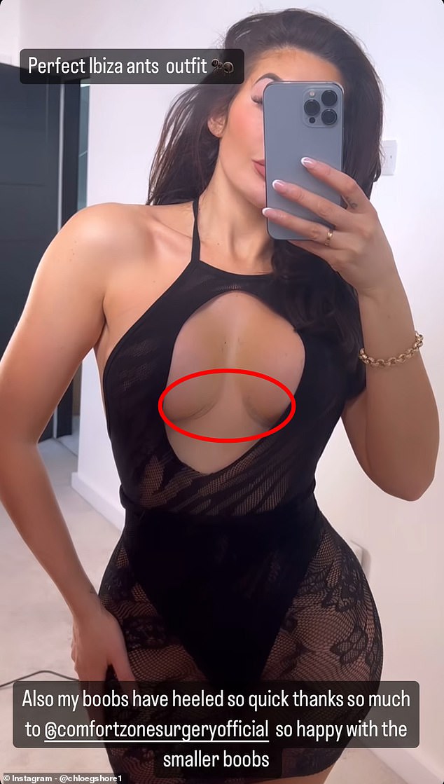 The reality star proudly showed off the scars from her corrective boob job on Instagram in a daring dress that had a cutout section.