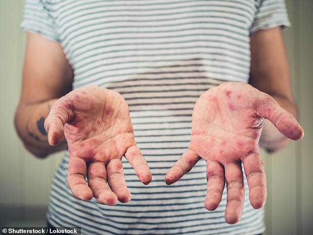 Nail peeling is a late symptom of hand-foot-mouth disease