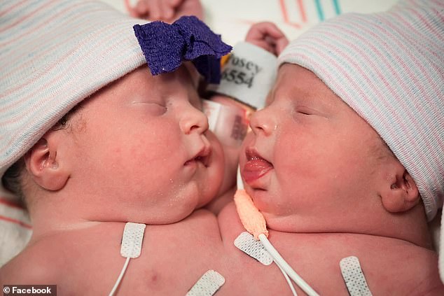 Doctors were so sure they wouldn't make it past the first day that the couple didn't buy them clothes, leaving them unprepared when the girls defied the odds and survived.