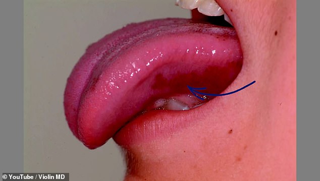 A 15-year-old female patient experiencing extreme sodium cravings also presented with pigmentation under her tongue, indicative of Addison's disease.