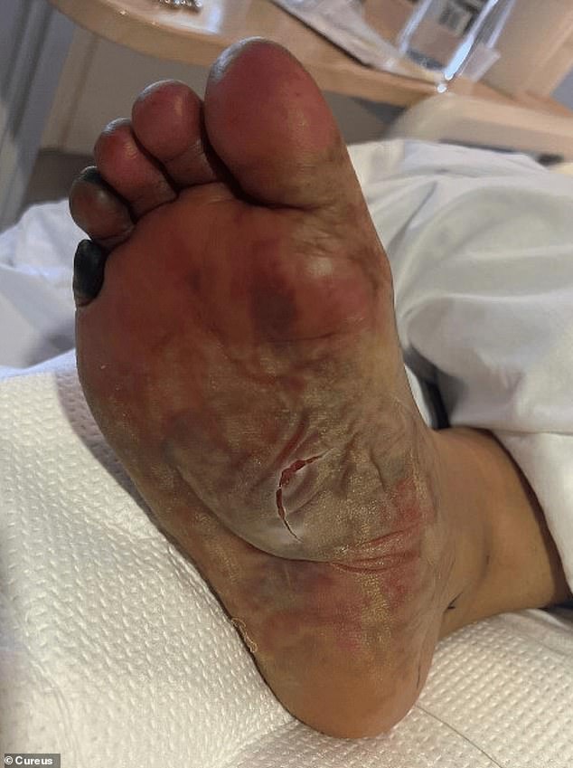 When the patient's circulation was cut off, her toe began to turn black. Doctors believe it may need to be amputated.