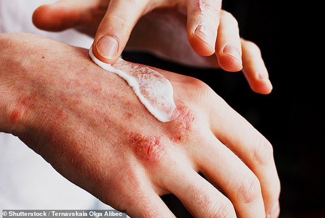 Eczema is a skin condition that causes red, dry, irritated patches to form all over the skin. It may form in response to an allergy or it may be a chronic condition.