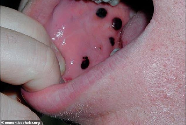 Idiopathic thrombocytopenic purpura (ITP): It is a rare autoimmune disorder that affects the number of platelets in the blood and one of the symptoms may be blackheads in the mouth.