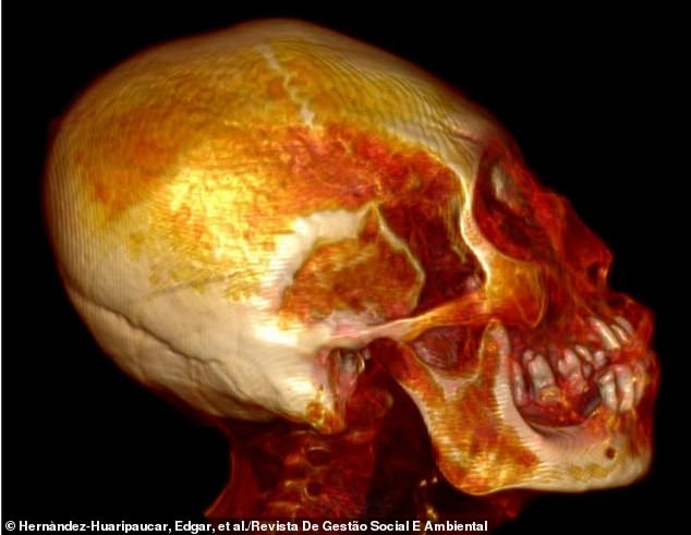 The elongated skull showed no signs of artificial cranial deformation and was 30 percent larger than that of a normal human.