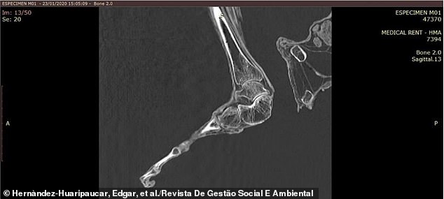 The specimen lacks a large lump on the foot that helps it support the weight of the body and maintain balance when standing on two feet. This suggested that he walked hunched over to remain stable.