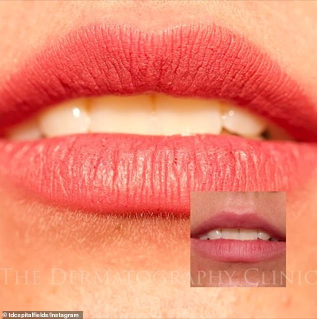 A photo of a woman's lips after receiving a permanent full lip contour at a dermatology clinic in London.