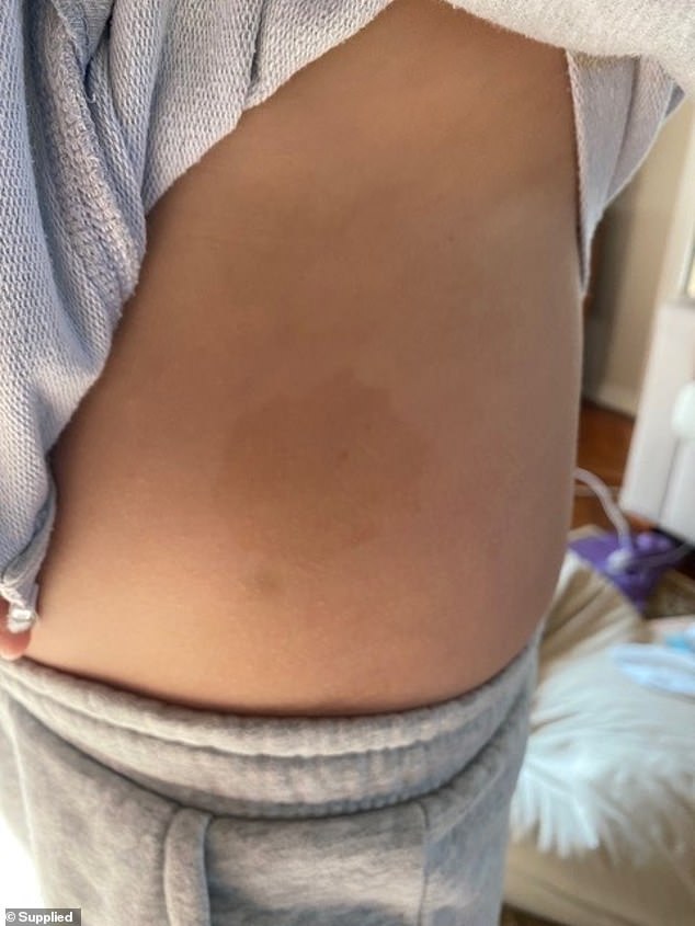 Tom's pediatrician noticed that he had café-au-lait spots on his body. Café-au-lait marks are pigmented birthmarks that are harmless in most cases, but they are a common sign of NF1.