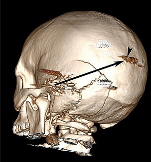 This scan shows the path of the bullet in the head.