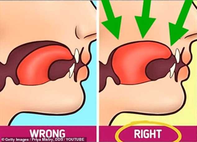 Correct tongue posture requires you to keep your entire tongue pressed lightly against the roof of your mouth with gentle suction. Incorrect posture includes a slight sagging of the tongue.