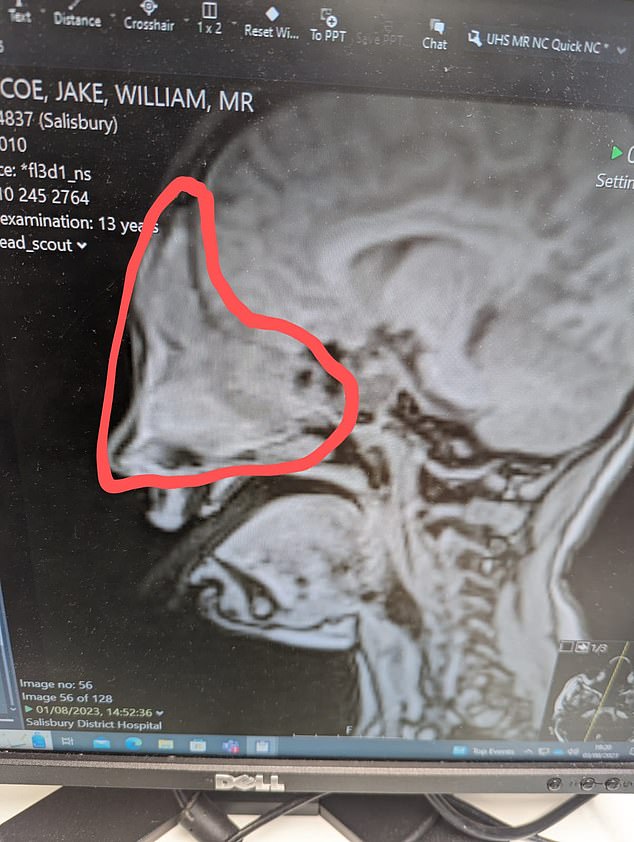 A CT scan revealed a growth inside Jake's skull that was the size of an egg and was pressing on his brain, which was causing the hay fever-like symptoms.