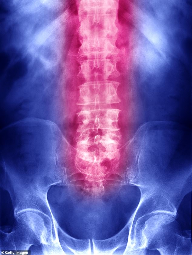 Fracture Liaison Services (FLS) identify people over the age of 50 who arrive at A&E with broken bones and screen them for fragility fractures (File image)