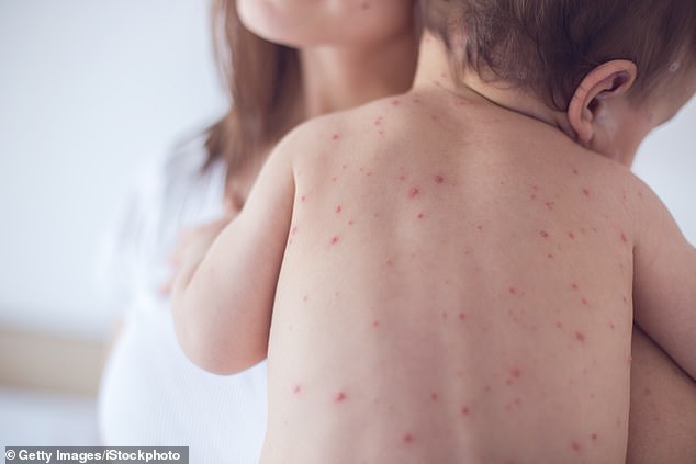 More than 90 percent of the population is immune to chickenpox, but newborns can develop complications from it.