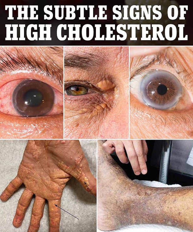 Yellowish bumps on the hands, yellow due to the color of fat deposits, are a hallmark sign that a person has high cholesterol. Yellow bumps around the eyes are usually not painful, but they may indicate that fats are building up in the bloodstream.