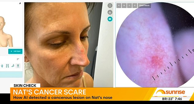 Natalie Barr shocked Sunrise viewers on Tuesday morning by revealing that she had recently been diagnosed with skin cancer.