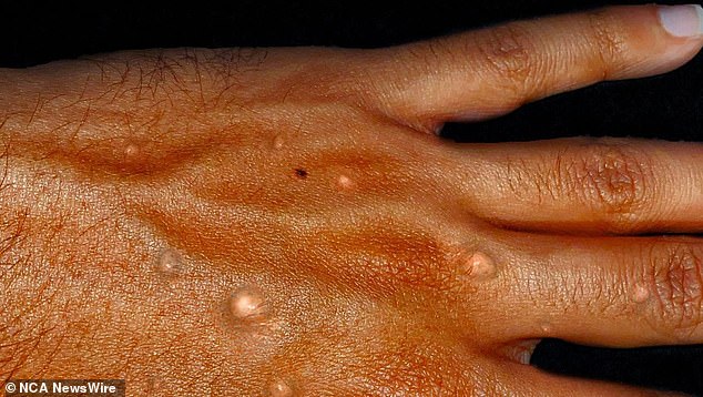 Mpox is transmitted through contact with body fluids.