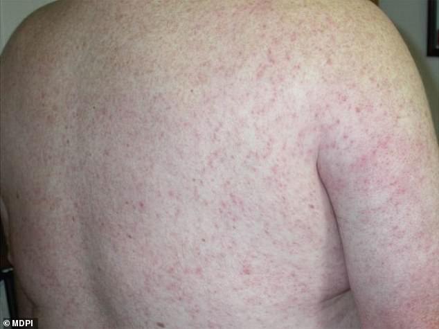 About one in five patients develop symptoms of West Nile, which can include a rash, as shown in the image above. Less than one percent of them have a severe form of the disease.