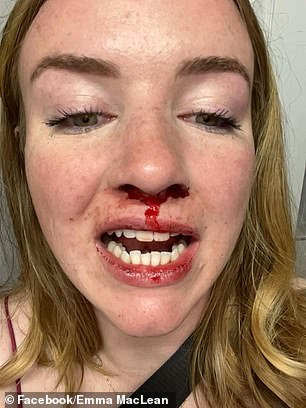 Emma MacLean said she suffered a chipped tooth, a broken nose and bruises as a result.