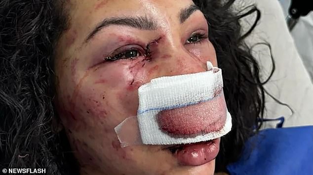 Former bodybuilder Nunes was taken to hospital in critical condition after suffering fractures to her eye sockets, jaw and nose, as well as numerous bruises. She will now require reconstructive facial surgery.