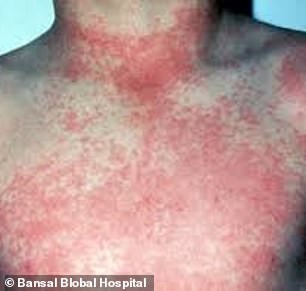 One of the symptoms of dengue is a rash like the one shown in the image above.