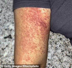 About one in four infected people experience symptoms of the virus, including a rash.