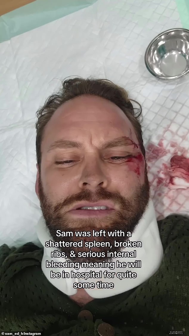 Sam was on the Padang Padang Bridge in the Uluwatu region when he was hit by a car, before another scooter ran over his body as he lay unconscious on the road.