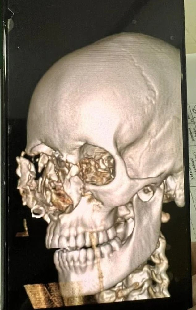 Ms Ode is likely to lose her right eye, which was severely damaged in the accident (her X-ray is pictured).