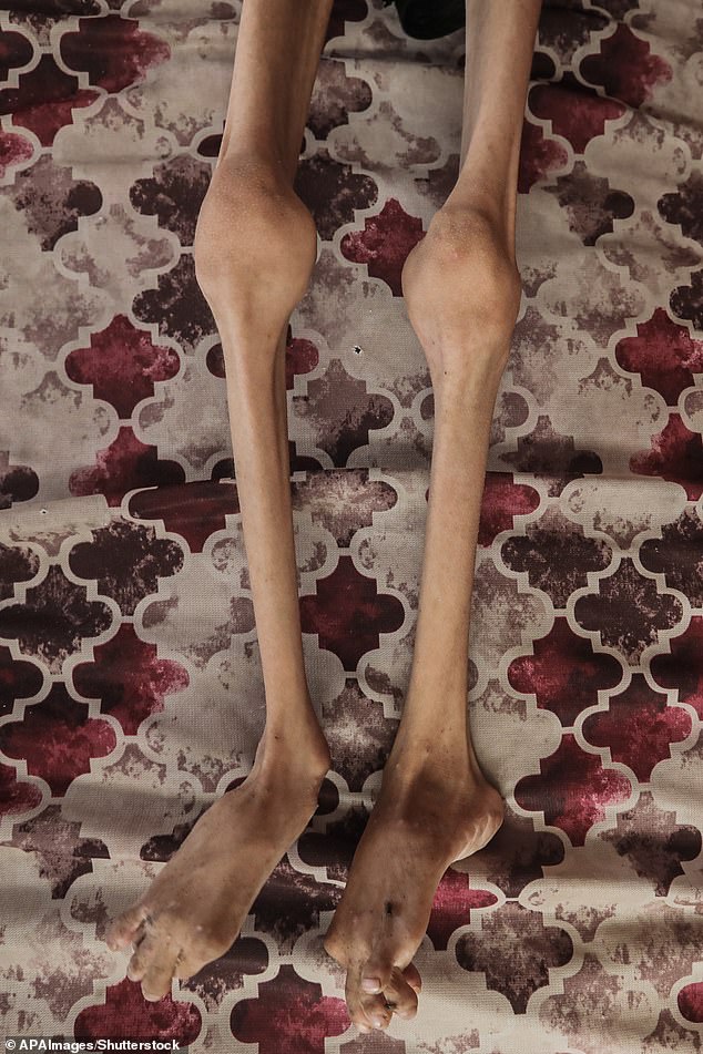 Disturbing images of her legs show her thin skin clinging to her bones with no fat or muscle visible to the naked eye.