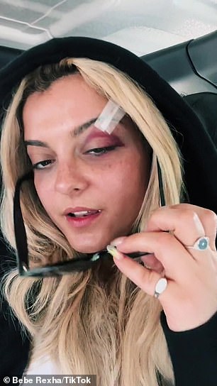 Rexha had to get 'three stitches' in her face after a fan's phone hit her in the face during a concert in New York City in June 2023.