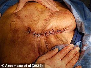 Surgeons were able to successfully place the woman's organs back into her body and close the wound again.