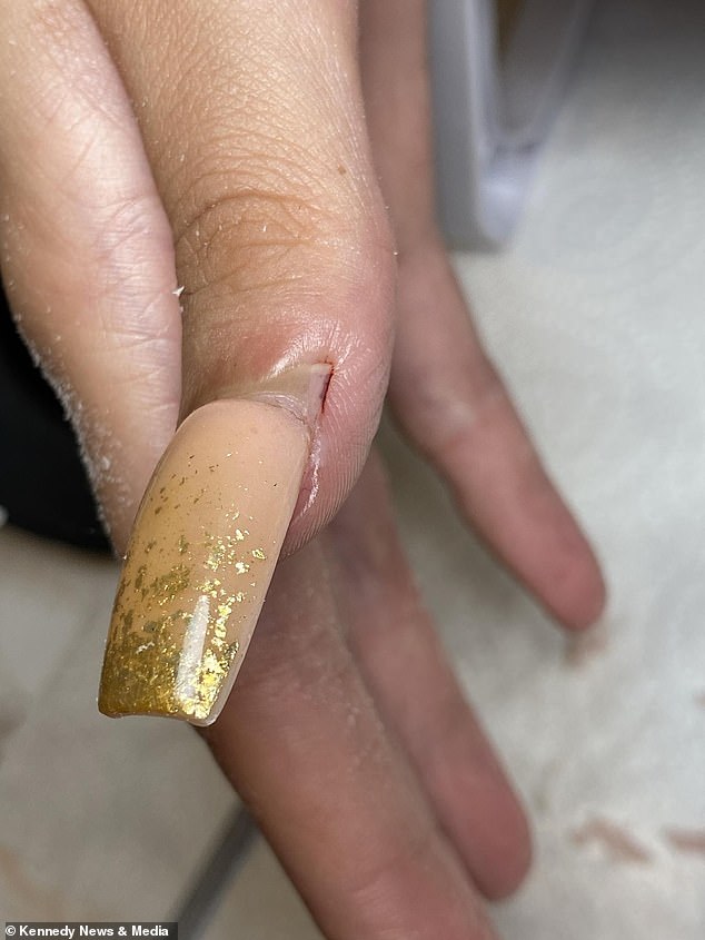 Ms Scott now believes Laylah's infection was caused by the chemical methyl methacrylate (MMA) used by the original salon. Pictured is Laylah's acrylic nail after she was hit