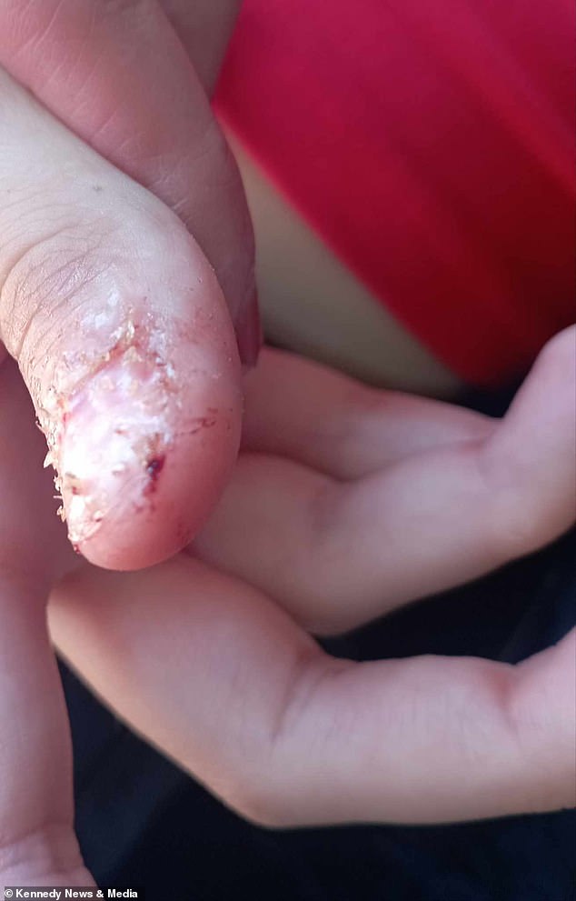 Ms Scott claimed that when Laylah hit her nails, her acrylic nails should have come off. However, the strong substance used caused her natural nails to come off.