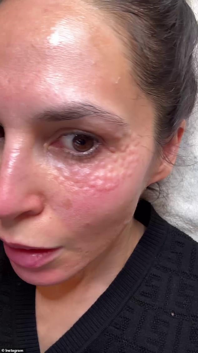 The 40-year-old gave her social media followers a close-up look at the skin under her eyes, which was dimpled, pockmarked and swollen.