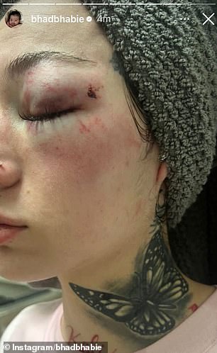 The 21-year-old rapper and OnlyFans star detailed the violence she claims he subjected her to and the shocking injuries she says she suffered (pictured)