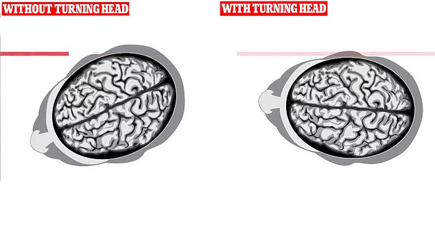 The bullet from crazed gunman Thomas Crooks passed through the president's brain and struck his ear.