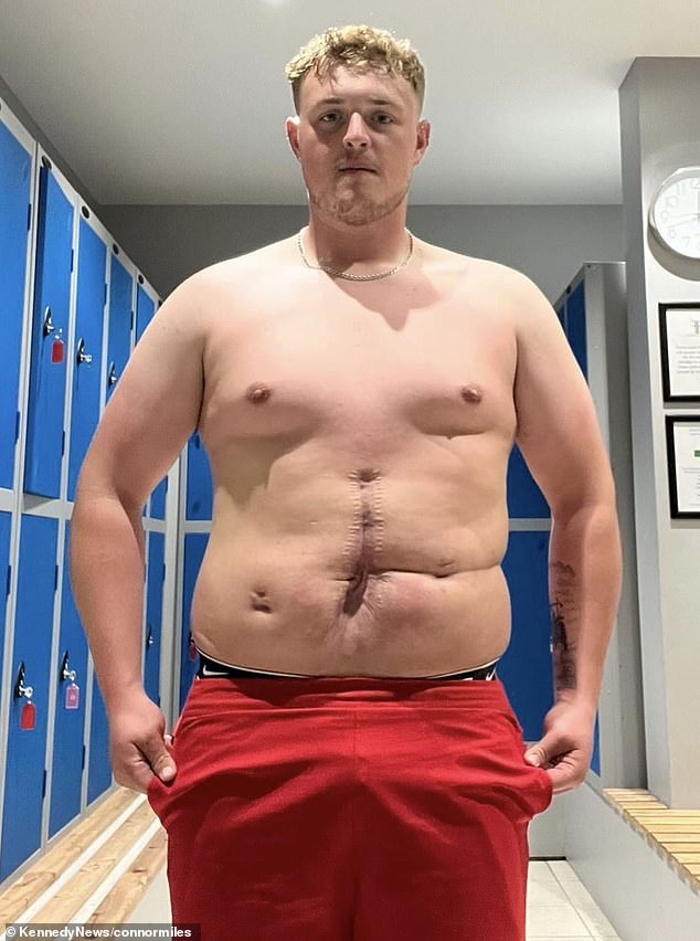 Connor Miles from Yorkshire, who gained 80lbs after a horror accident left him with just a two per cent chance of survival, has been transformed and left women swooning.