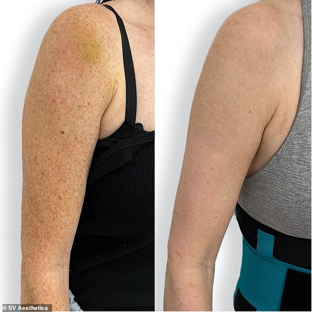 Denise Farrell, 55, from London, before and after three sessions of Lumecca on her arms.