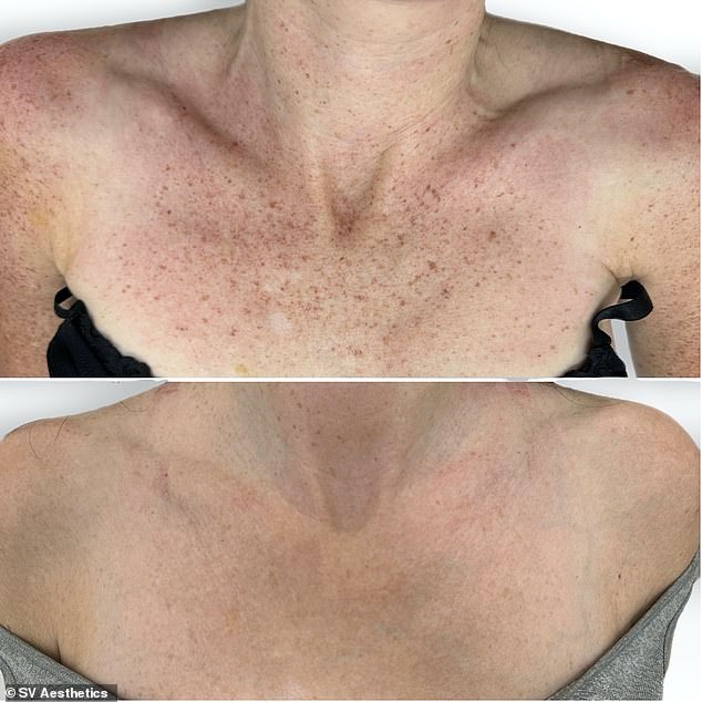 Mary Sexton, 45, from London, had the treatment on her neck and chest and noticed results after two sessions.