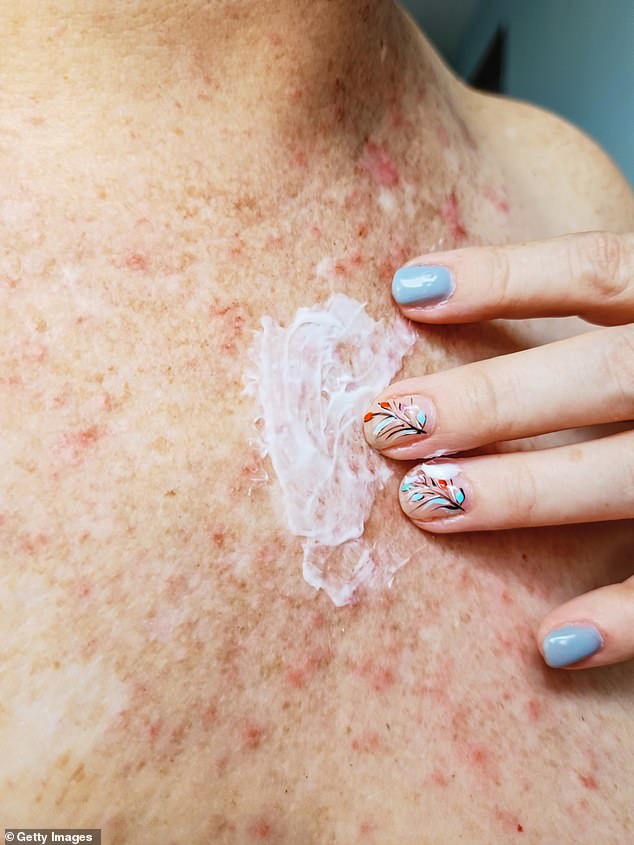 The monthly injection can be used by adults and children over 12 years of age affected by the inflammatory condition, which causes uncomfortable patches of itchy, cracked and dry skin (eczema stock image)