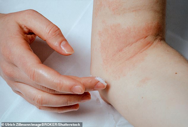 Pictured: A woman applies eczema ointment to her elbow.