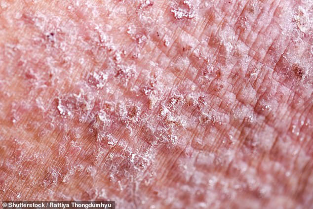 Pictured: A close-up view of atopic dermatitis, also known as atopic eczema, one of the most common forms of eczema.