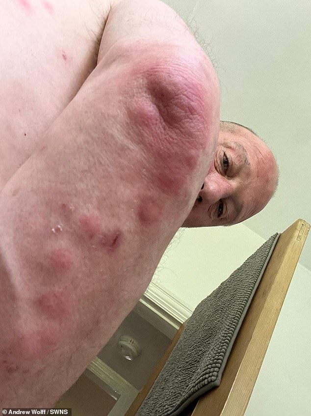 Two days after receiving a discounted sofa, she says her arms and legs were covered in bites, which she has been treating with antihistamines and tubes of steroid cream.