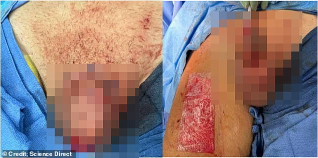 Doctors eventually replaced the dead penis tissue they had removed with a skin graft taken from the patient's thigh.