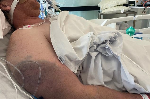 Mr Briggs (pictured in hospital) spent eight days in a coma.