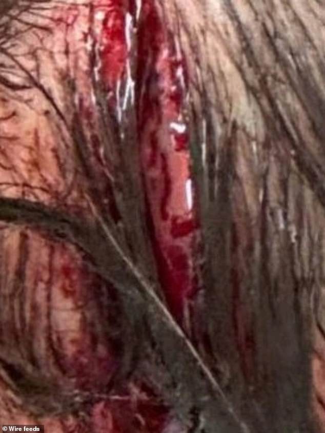 Pictured: The horrific head wound suffered by a 17-year-old boy in the alleged assault.