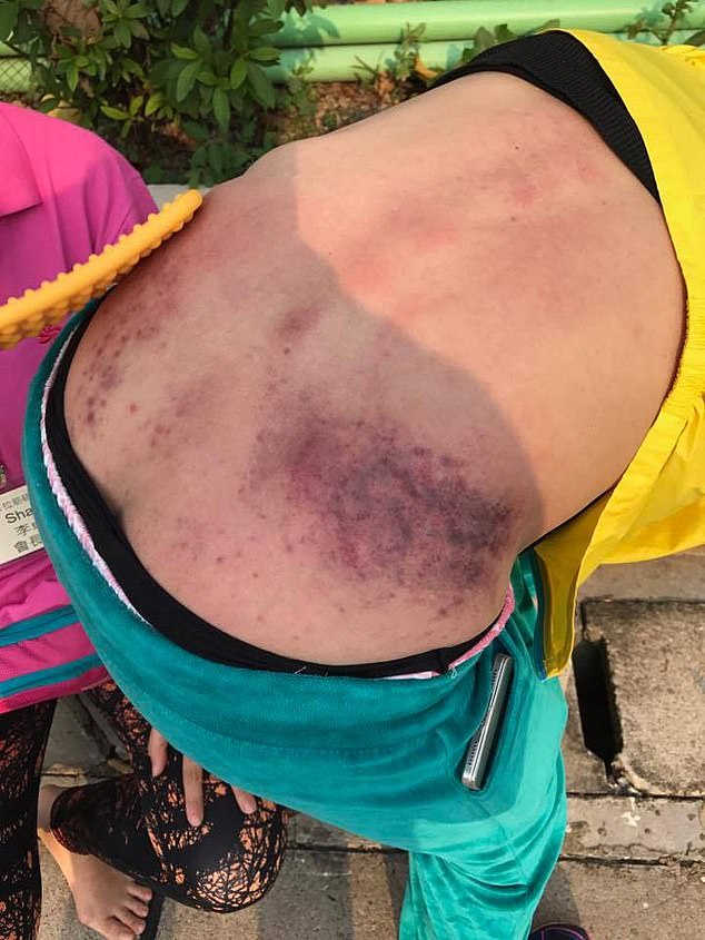 A person shows off her injuries after a slap therapy session, with a huge black mark visible on the right side of her lower back.