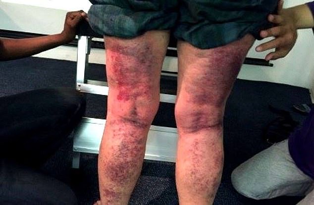 A person covered in red marks on the back of his legs after participating in a paya lajin.