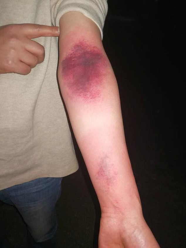 Bruises on forearm caused by repeated slapping