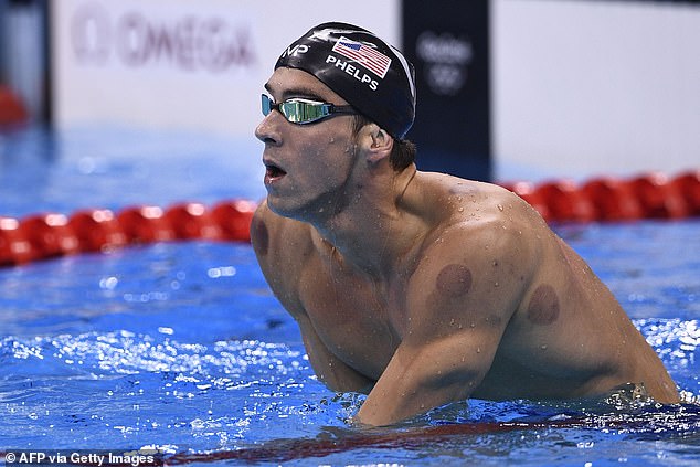 Michael Phelps was a fan of cupping therapy and won five gold medals at Rio 2016 after practicing it.