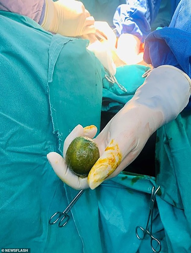 Doctors manipulated the lemon down through the patient's anus until it came out before sewing up the hole in his intestine.